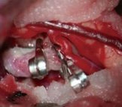 Aneurysma mit Clips